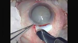 Cataract Surgery service
