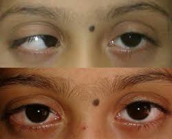 Squint Treatment service