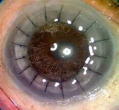 Cornea Care service